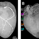 Illustration for article titled These Are the First Ever Images of a Heart Injected With Liquid Metal